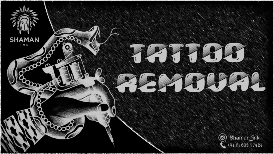Tattoo Removal
